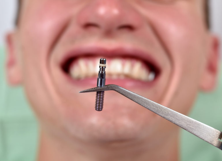 Dental Implants Grand Parkway Smiles